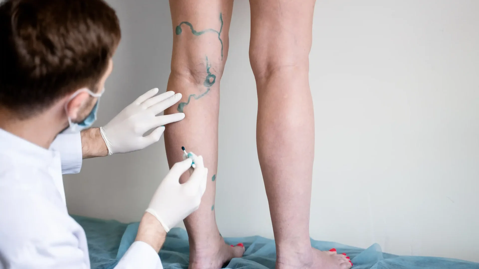 vein-markup-vascular-surgeon-is-marking-veins-varicose-surgery (2)